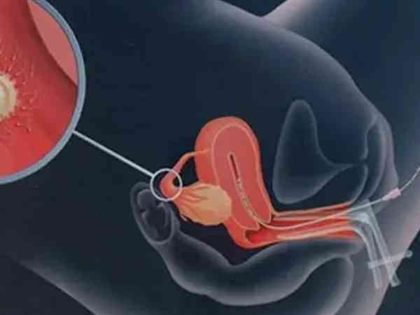 做人工授精是将精子放在子宫腔、阴道还是输卵管？