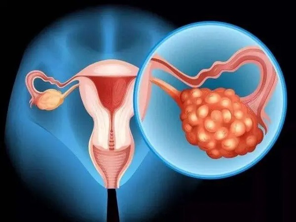 多囊卵巢做试管婴儿促排卵会过度刺激有生命危险吗？