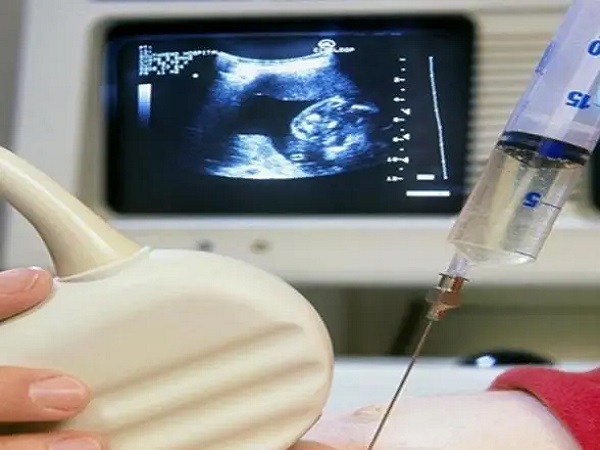 0pn囊胚移植成功后必须要做羊水穿刺检查是否有畸形吗？