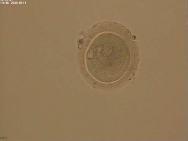 养囊五天和直接移植第三天的鲜胚哪个成功率高些？
