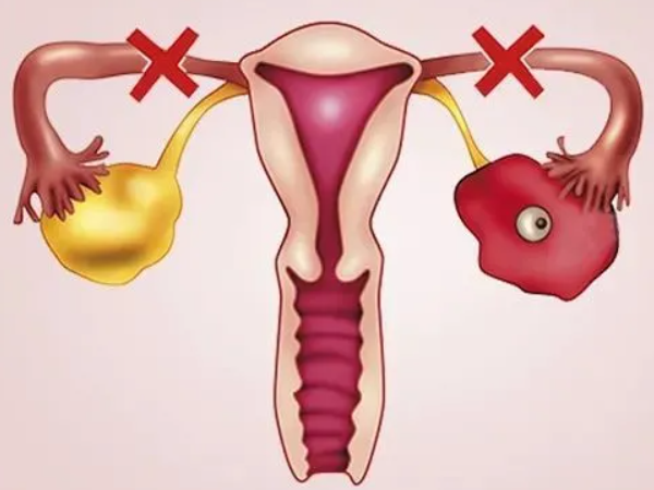 女性输卵管堵塞不通怎么办才能快速好孕？