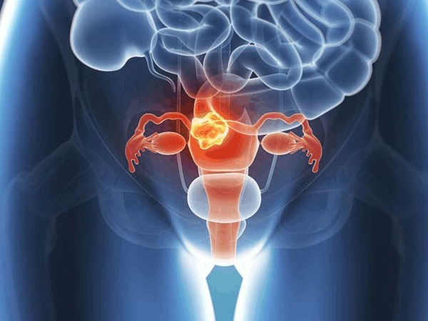 女性排卵障碍会出现月经不调的症状吗？