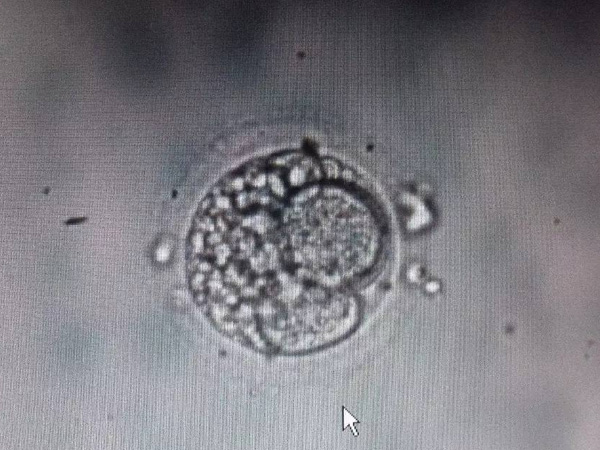 6ab和5ab这种等级不同的囊胚可以一起移植吗？