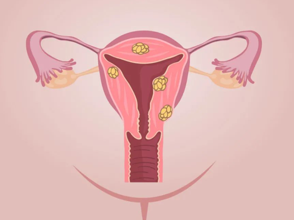 子宫肌瘤和滥用避孕药有关，还能顺利怀孕吗？