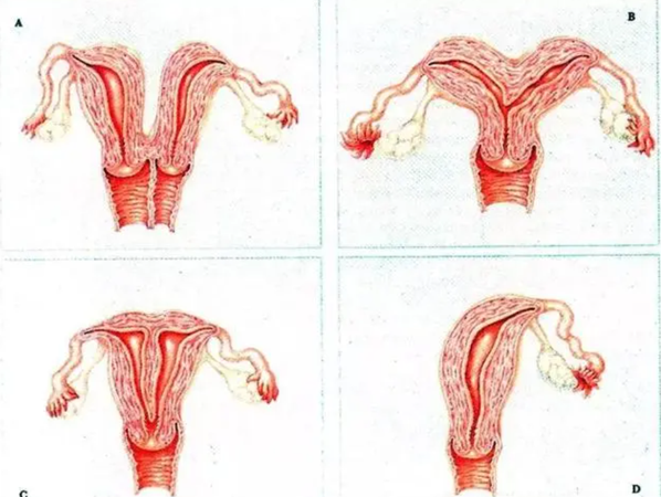 单角子宫和双角子宫形态差异大，哪个更影响生育功能？