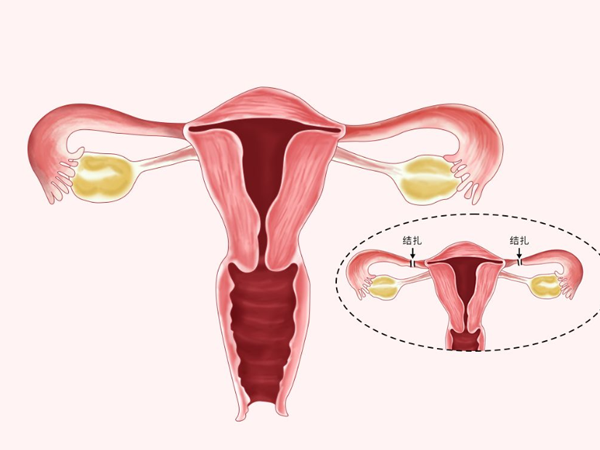输卵管结扎在壶腹部修复难度最低，还有其他部位选择吗？