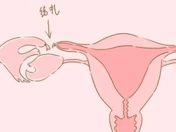 输卵管结扎对女性的损伤有哪些，会不会影响生殖系统？