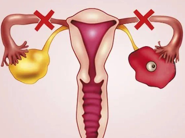 预防子宫内膜异位症需要做到月经期禁止性生活吗？