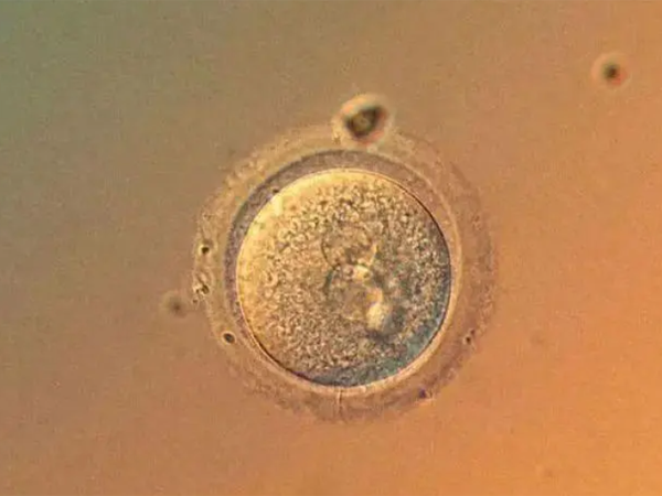 试管婴儿空卵泡多的原因一定是卵巢功能异常吗？