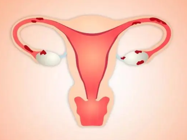 34岁I期内异症病灶在阴道壁会降低怀孕的几率吗？