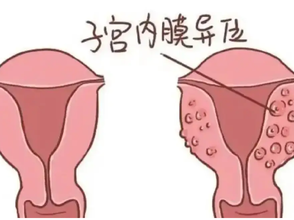 检查子宫内膜异位症选B超还是阴道镜更好？