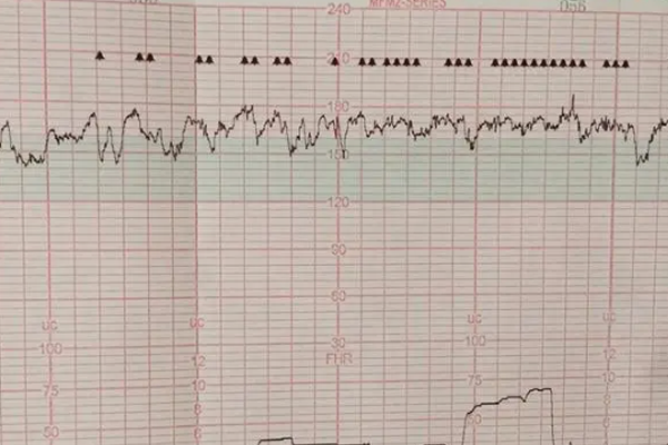 孕晚期胎心监护标准图除了基本心率线还要看什么？