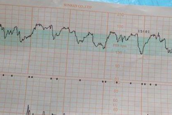 胎心基线低于110说明胎儿存在异常吗？