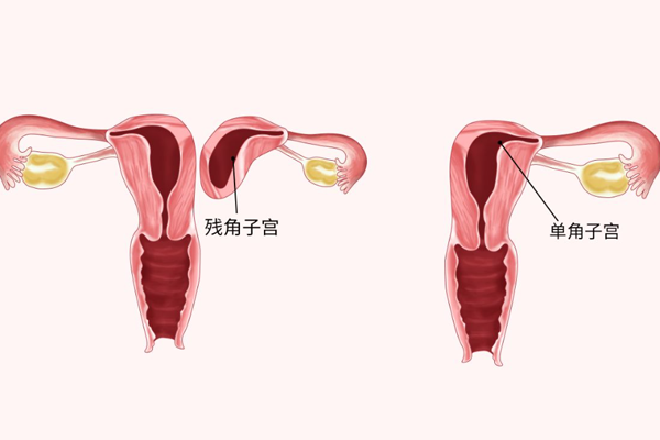 畸形子宫生育出现流产和宫外孕的风险更大吗？