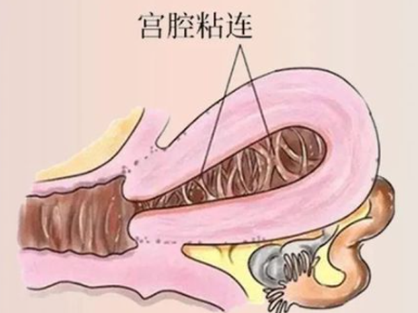 严重宫腔粘连会引发内异症从而降低怀孕几率吗？