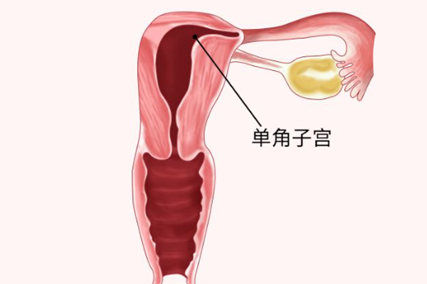 5cm单角子宫做试管婴儿放1个囊胚风险最小吗？