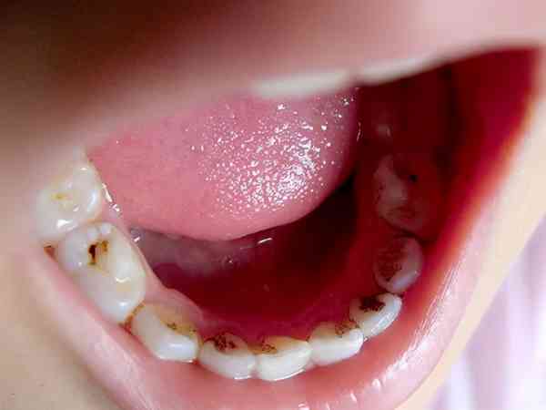 儿童矫正牙齿的最佳年龄段是在8岁吗？