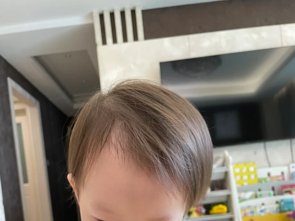 一岁半宝宝头发发黄开叉是营养不良导致的吗？