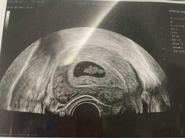早孕6周做b超报告单显示未见胎心胎芽正常吗？