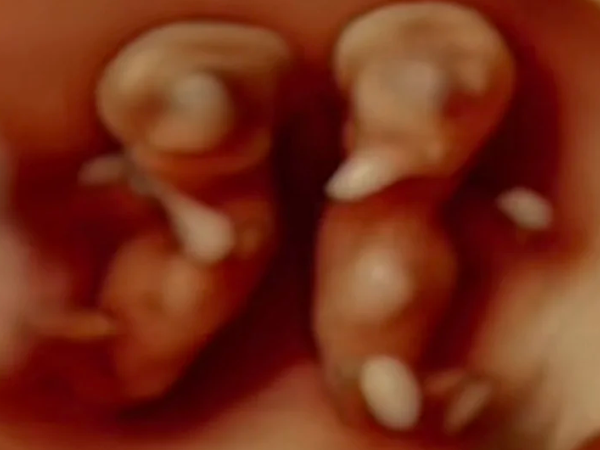 试管婴儿做的双胞胎长大以后会携带双胞胎基因吗？