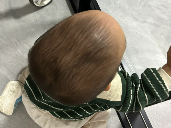 婴儿佝偻病前额凸起是长什么样子的？有没有图片？
