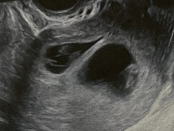 试管婴儿移植2胚胎生双胎对母体的伤害有多大？