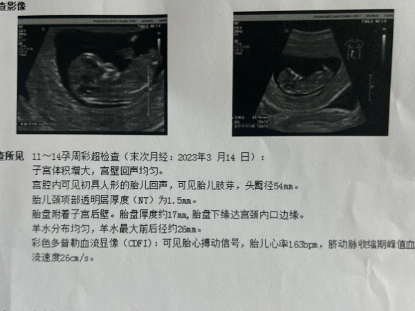 三代试管婴儿做了nt检查还要做唐氏筛查吗？