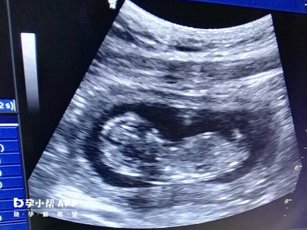 7个月B超影像生殖器官已经非常明显了