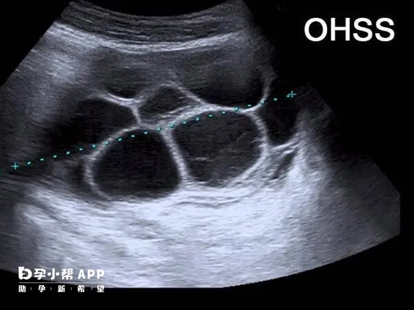 有多囊需要用拮抗剂方案