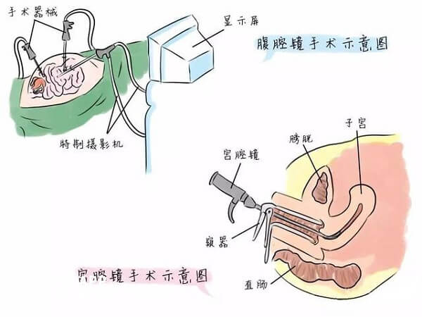 宫腔镜手术过程示意图