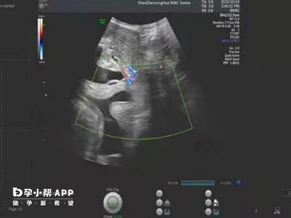 怀孕9周胎儿b超图