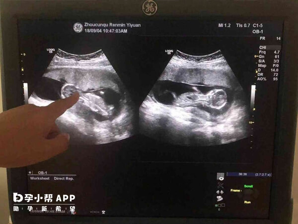 孕13周胎宝宝b超图