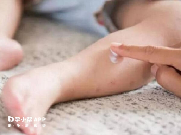 宝宝被蚊虫叮咬后可以给宝宝涂上婴幼儿专用的药膏