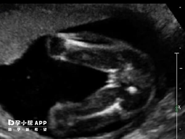 如果胎儿的腿之间没有明显的凸起那可能是女孩