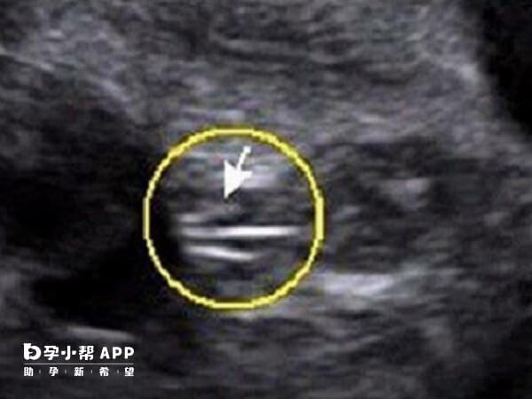 女孩胎儿在24周的时候看双腿间的话会有白线