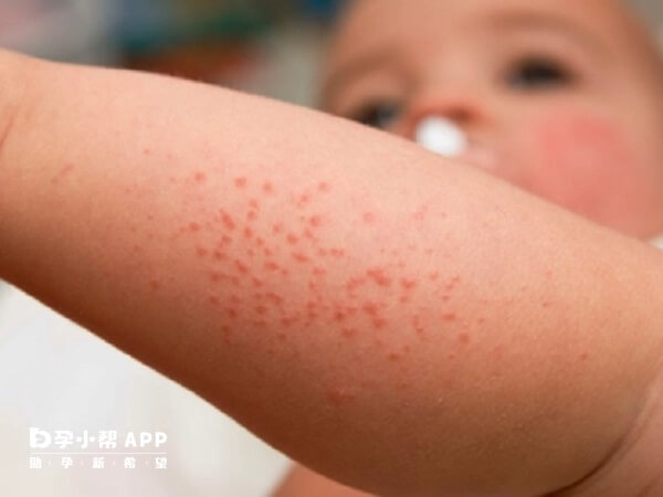 宝宝湿疹可以在洗完澡后涂抹润肤乳来保持皮肤的湿润