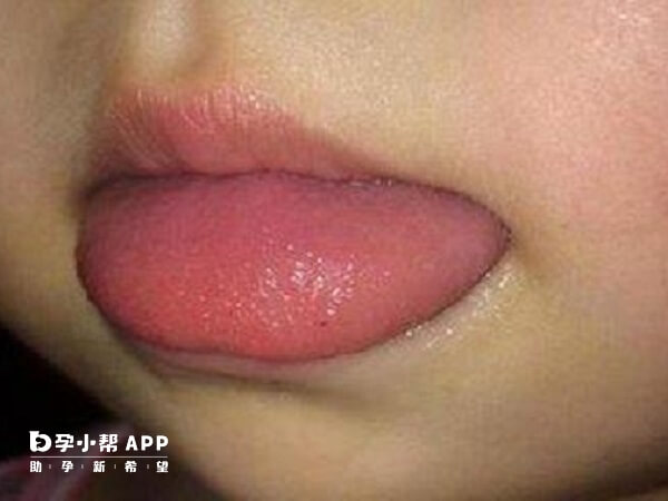 如果宝宝感冒发烧首先表现为舌质发红