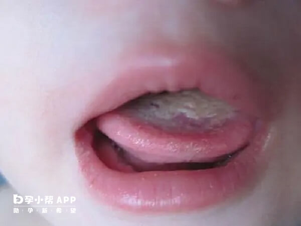 鹅口疮经常在口腔不清洁的婴儿中发病