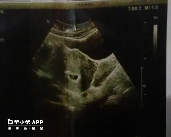 孕囊长出一周后可见胎心胎芽