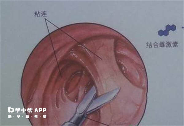 粘连的子宫腔只能容纳较小的胎儿