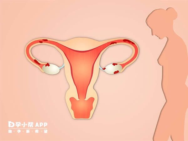 巧囊可以通过试管婴儿技术获得怀孕