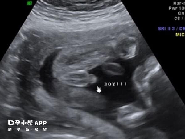 16周的时候胎儿的生殖器官已经开始发育了