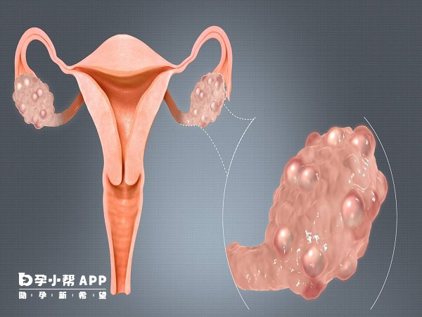 输卵管存在炎症大部分会有积水