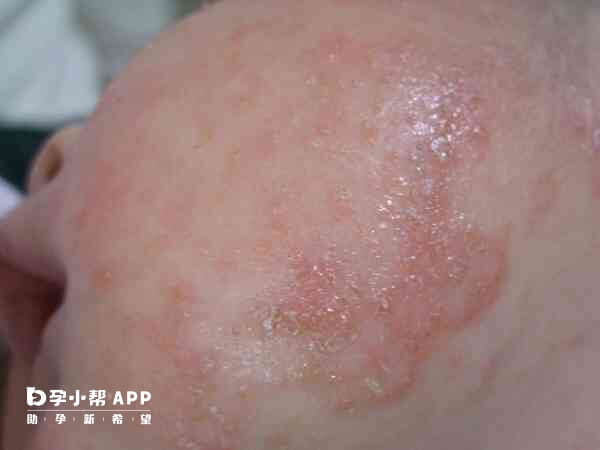 湿疹可以通过症状来区分严重程度