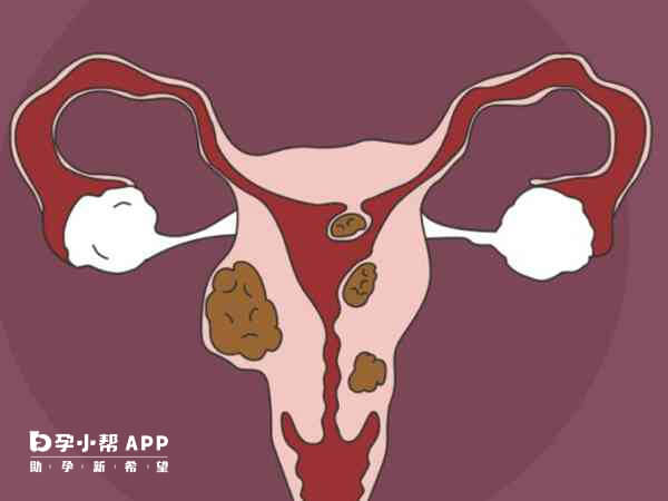子宫肌瘤还可能导致输卵管移位