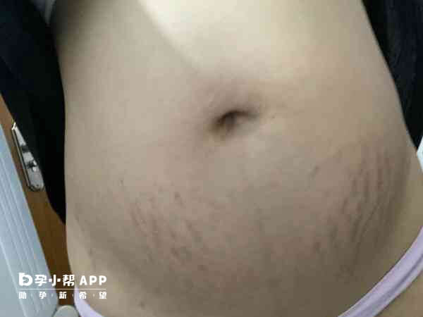 大多数孕妇的妊娠纹长在肚皮上