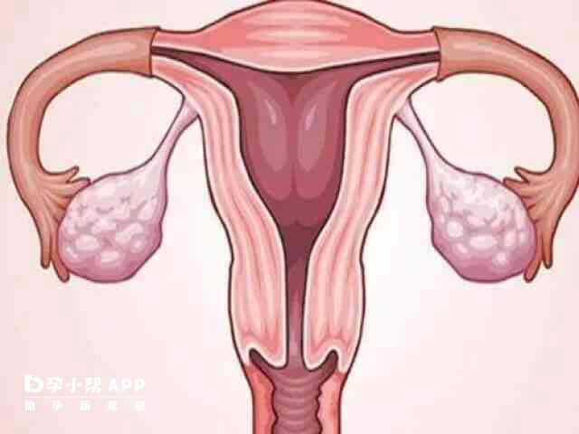 卵巢囊肿的危害需要分生理性以及病理性
