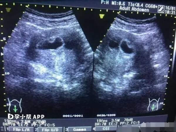 一个孕囊的双胞胎属于单卵双胎