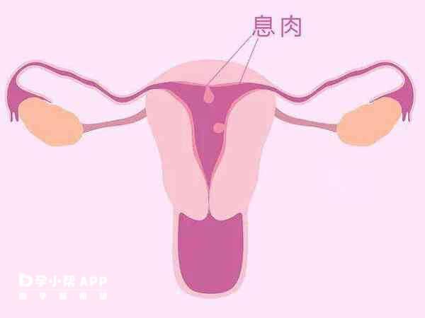 子宫内膜息肉通常与雌孕激素有关