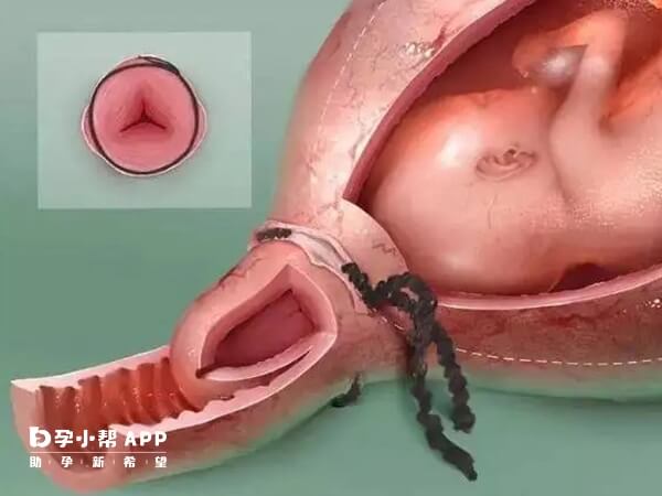宫颈环扎通常用于防止早产
